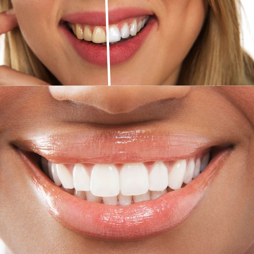 How to Whiten your teeth Naturally in 2 days.
