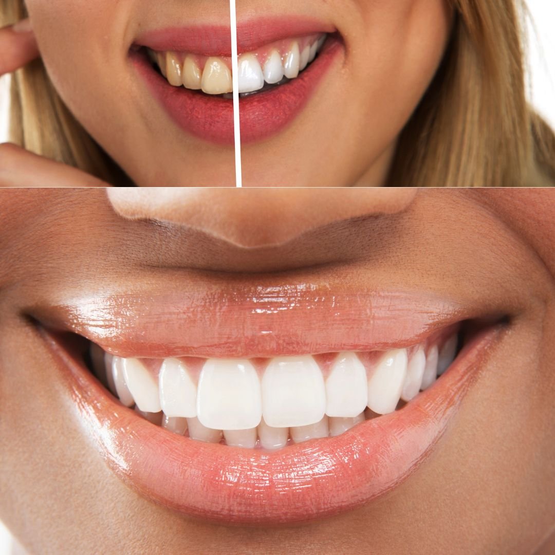 How to Whiten your teeth Naturally in 2 days.
